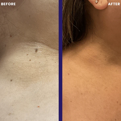 TagPal - Skin Tag Removal Kit La Tienda Nexo