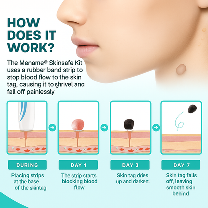 TagPal - Skin Tag Removal Kit La Tienda Nexo