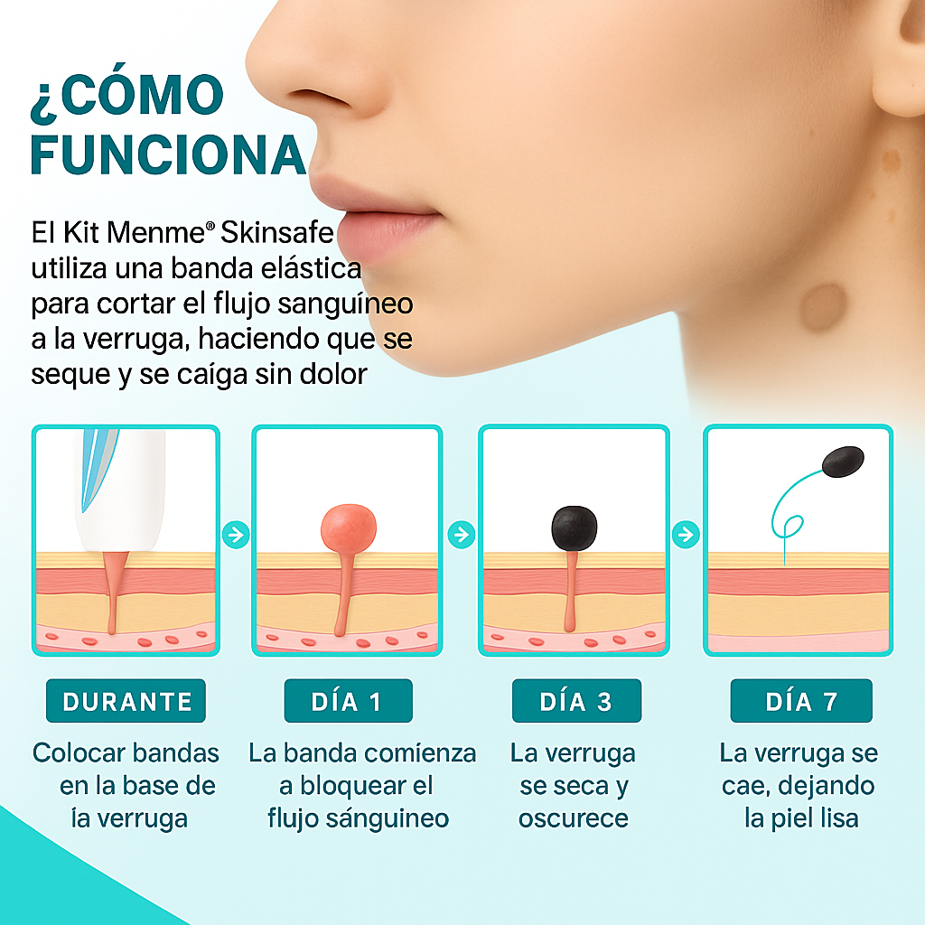 TagPal™ – Elimina Verrugas de Forma Segura y sin Dolor en Casa TAGPAL