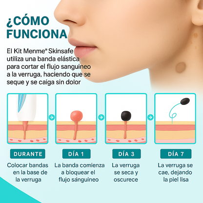 TagPal™ – Elimina Verrugas de Forma Segura y sin Dolor en Casa TAGPAL
