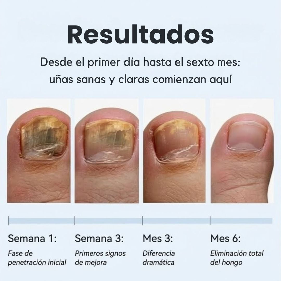 ClearNail Pro™ Lápiz Antihongos