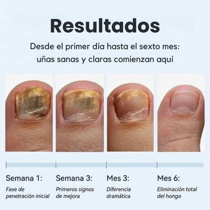 ClearNail Pro™ Lápiz Antihongos