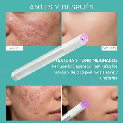 LaserClear Pro™ Elimina verrugas y manchas con precisión