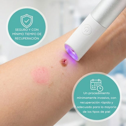 LaserClear Pro™ Elimina verrugas y manchas con precisión