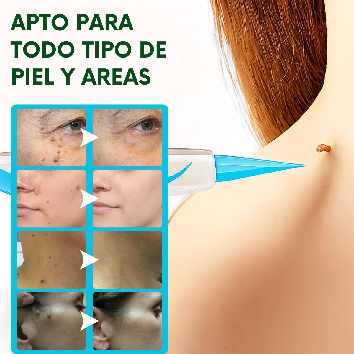 TagPal™ – Elimina Verrugas de Forma Segura y sin Dolor en Casa TAGPAL