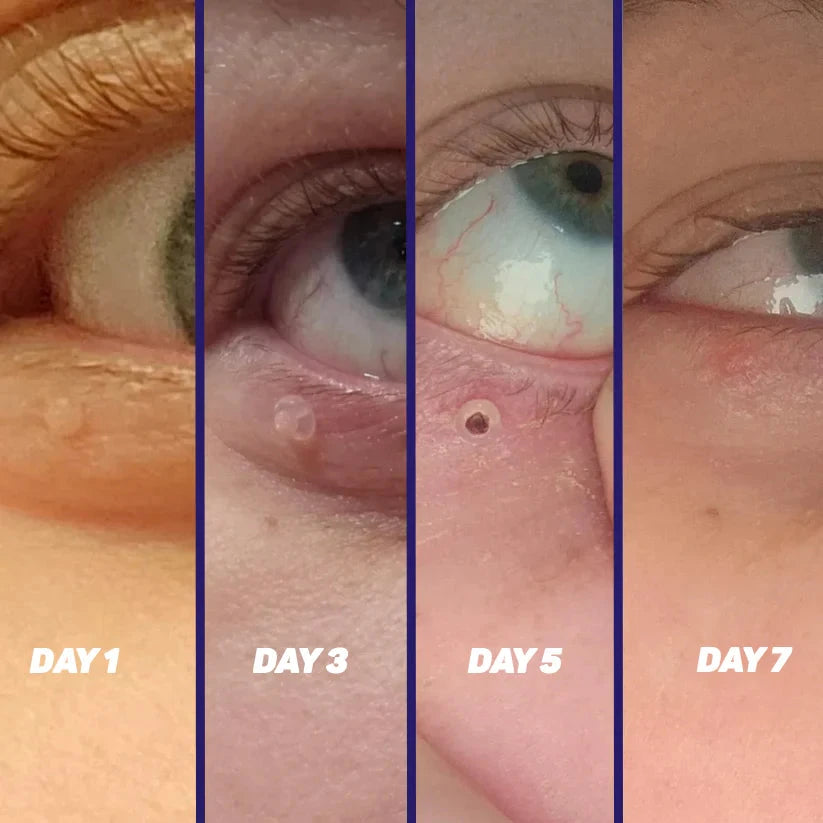 TagPal - Skin Tag Removal Kit La Tienda Nexo